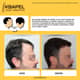 Slider image (8) Kbapel Hair Transplant